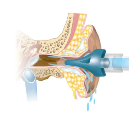 irrigation earwax removal audiology island 1